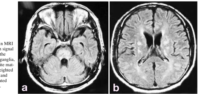 Fig. 1.  Brain MRI  showed high signal  intensity in the  pons, basal ganglia,  cerebral white  mat-ter on T2 weighted  imaging (a) and  fluid attenuated 
