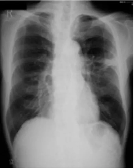 Fig. 1.  Chest X-ray showed an irregular-circumscribed  abnormal shadow in the left middle field of the lung.