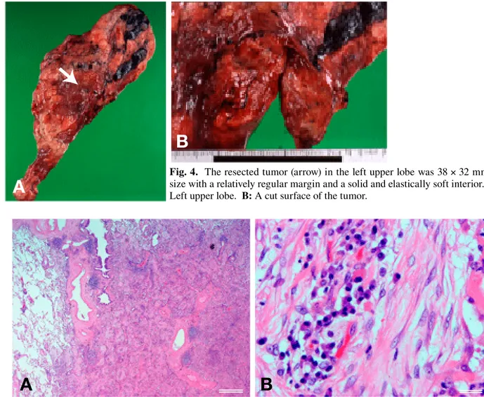 Fig. 5.  Pathological findings showed inflammatory cell infiltration involving lymphocytes and plasma cells, fibrosis  and spindle-shaped mesenchymal cells with hematoxylin and eosin staining of low power field (A) and high power  field (B)