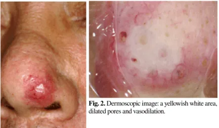 Fig. 1. Clinical feature: a red nodule on the nasal tip.