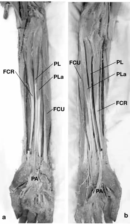 Fig. 1. Photographs of superficial flexor muscles of the forearm. Note  PLa between PL and FCU