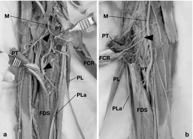 Fig. 2. Photographs showing the median nerve and its branches to flexor muscles. The belly of the pronator teres is cut  and opened for the demonstration of the innervation
