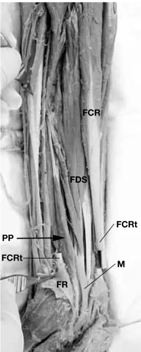 Fig. 3. Photograph of the anterior side of the right fore- fore-arm, showing the palmaris profundus muscle (PP with  arrow)