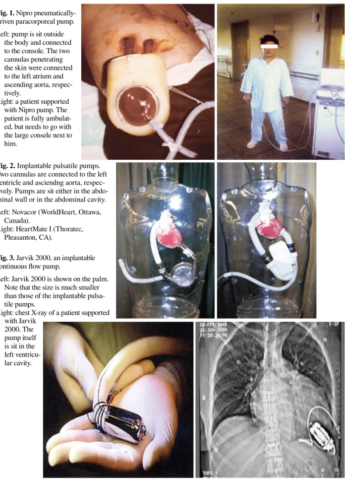 Fig. 2. Implantable pulsatile pumps. 