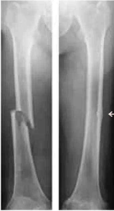Fig. 5.  Case of an atypical femoral fracture. An 81-year-old  women suffered a right femoral shaft fracture upon falling  on the road