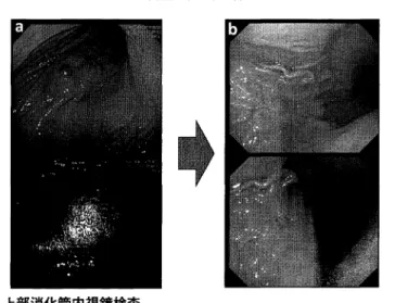 図 1 上部消化管内視鏡検査 初診時には胃体部大鰐に粘膜下腫癒様隆起と撲の肥厚を認めた ( a ) が ， DCS 療法2 コース後には隆起は平坦化し，中央に疲痕様の変化を認めた ( b ).  図 2 腹部造影 CT 検査 初診時には胃体部大轡に造影効果を有する壁肥厚を認めた ( a ;矢印) DCS 療法2 コース後には壁肥厚は改善していた明らかなリンパ節の腫大 や遠隔転移は認めなかった ( b ) 他に特記異常を認めなかった