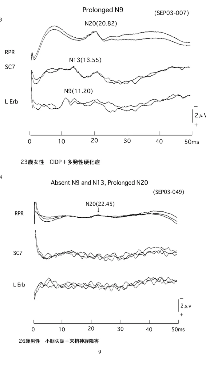 図 I-3 図 I-4 + 2μV01020304050msRPRSC7L ErbN20(20.82)N13(13.55)N9(11.20)−23歳女性　CIDP＋多発性硬化症(SEP03-007)Prolonged N9 + 2μv 0 10 20 30 40 50ms(SEP03-049)RPRSC7L ErbN20(22.45)− 26歳男性　小脳失調＋末梢神経障害