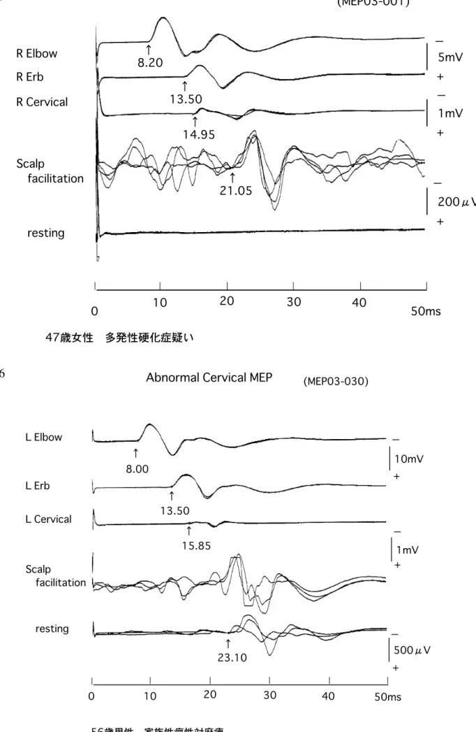 図 II-5 図 II-6 0 10 20 30 40 50ms + 200μV+1mV+5mV(MEP03-001)R ElbowR ErbR CervicalScalp　facilitation　resting