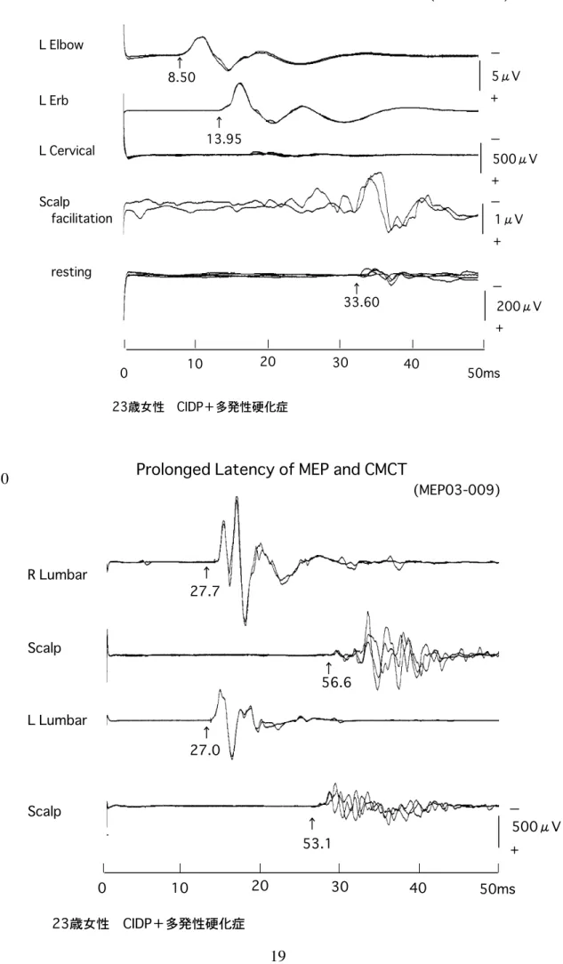図 II-9 図 II-10 + 200μV01020304050ms+500μV+1μV+5μV(MEP03-009)L ElbowL ErbL CervicalScalp　facilitation　resting8.5013.9533.60↑↑↑
