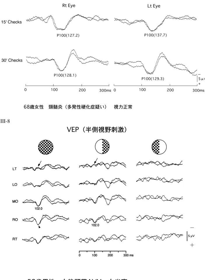 図 III-7 図 III-8 Rt Eye Lt EyeP100(127.2) P100(137.7)Binocular Prolonged P1000100200300ms15' Checks0100 200 300ms−+ 5μvP100(129.3)P100(128.1)30' Checks68歳女性　頸髄炎（多発性硬化症疑い）　視力正常(VEP03-009) VEP（半側視野刺激） 52歳男性　右後頭葉AVM　左半盲 −＋