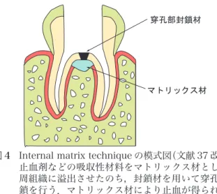 図 4  Internal matrix technique の模式図（文献 37 改変）． 止血剤などの吸収性材料をマトリックス材として歯 周組織に溢出させたのち，封鎖材を用いて穿孔部封 鎖を行う．マトリックス材により止血が得られ，ま た，封鎖材を溢出させることなく緊密に充填できる．