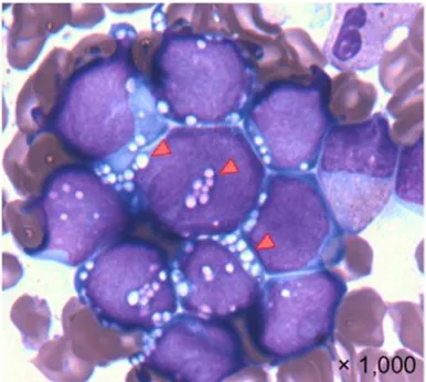 図 2. MEF2D-BCL9 融合遺伝子 白血病細胞 典型的 B 前駆細胞性 ALL 異 細胞 大 細胞質 青味 強 白 抜け 空胞 △ 多 特異 形態 示 ．今後 展開 本研究 発見 機能 明 MEF2D-BCL9 融合遺伝子 子 ーカー ス 層 化や治療効果 定 早期 実用化 可能 考え 融合遺伝子 持 白血病 対 子標的薬 組 入 新 い治療方針 策定や 融合遺伝子 標的 新薬開発 応用研究 進 児 ALL 治療成績 向上 期待 図 3 図 3