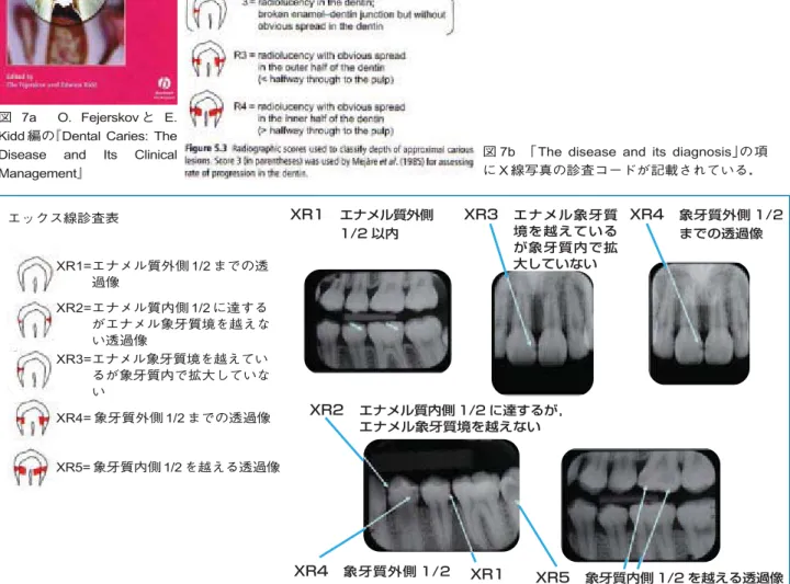 図 7b 「The disease and its diagnosis」の項 に X 線写真の診査コードが記載されている． 図 8 日本ヘルスケア歯科研究会のオリジナル エックス線診査 ンコード．XR1=エナメル質外側 1/2 までの透過像XR2=エナメル質内側 1/2 に達するがエナメル象牙質境を越えない透過像XR3=エナメル象牙質境を越えているが象牙質内で拡大していないXR4= 象牙質外側 1/2 までの透過像XR5= 象牙質内側 1/2 を越える透過像
