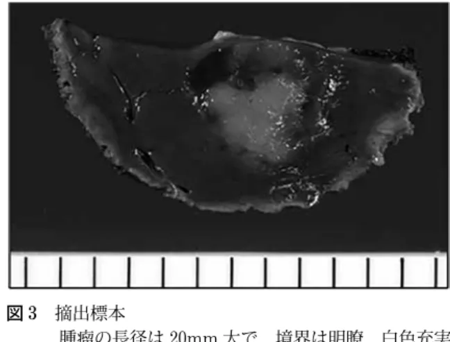 図 2 造影超音波検査（a: Vascular Image ，Early phase, b: Vascular Image ，Late phase，c: Kupper Image ） 肝 S6  の腫瘤は，Vascular Image ，Early phase にて早期濃染し，Late phase にて濃染持続が持続，Kupper  Image  にて欠損像を認めた．図1 腹部超音波検査肝S6に27mm 大の低エコー腫瘤，S7 に 26mm大の高エコー腫瘤を認めた． 図 3  摘出標本 腫瘤の長径は 20m