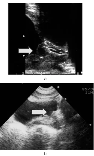 Fig. 1. a : Computerized tomography (CT) ﬁnding. Left adrenal tumor of 6 cm in size was observed in plain CT (arrow)