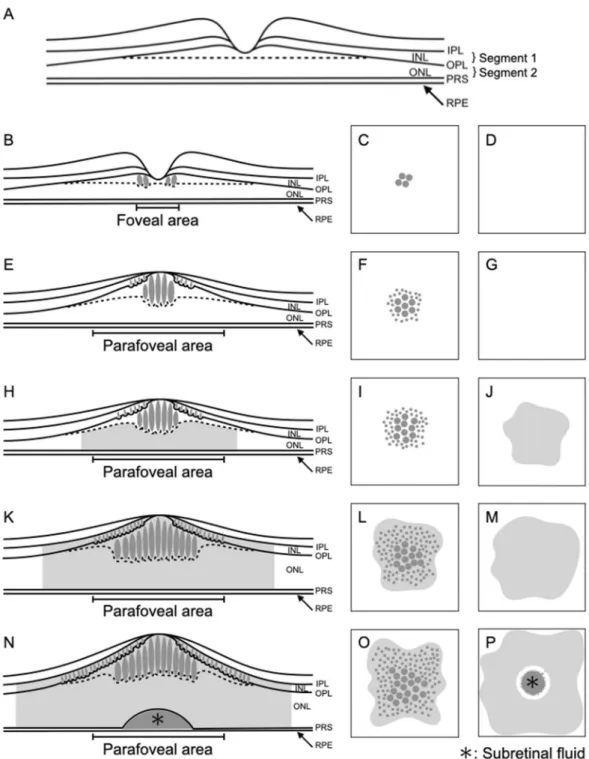 Figure 10.  Schematic illustration of the en face image-based classification of diabetic macular edema (DME)