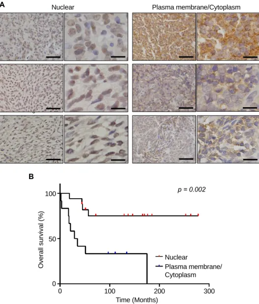 Figure 4. Immunohistochemical staining of MCT1 in SS tissue specimens. (A) SS tissues showing MCT1 expression in the  nucleus (left) and cytoplasm/membrane (right)