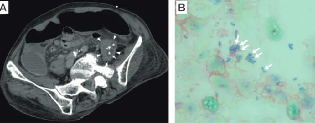 Fig. 2　 Initial abdominal computed tomography (CT) image and results of Gram staining for a 79-year-old woman with endogenous bac- bac-terial endophthalmitis secondary to iliopsoas abscess