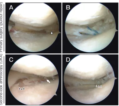 Fig. 3　 Arthroscopic ﬁndings of the present case with  pullout  repair  of  medial  meniscus  posterior  root  tear  (MMPRT)