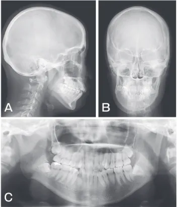 Fig. 3　 Pretreatment cephalograms and a panoramic radiograph.  