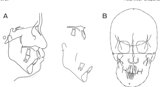 Fig. 7　 Superimposed  cephalometric  tracings  showing  the  changes  from  the  pretreatment  (solid  line)  to  posttreatment  (dotted  line)  stages