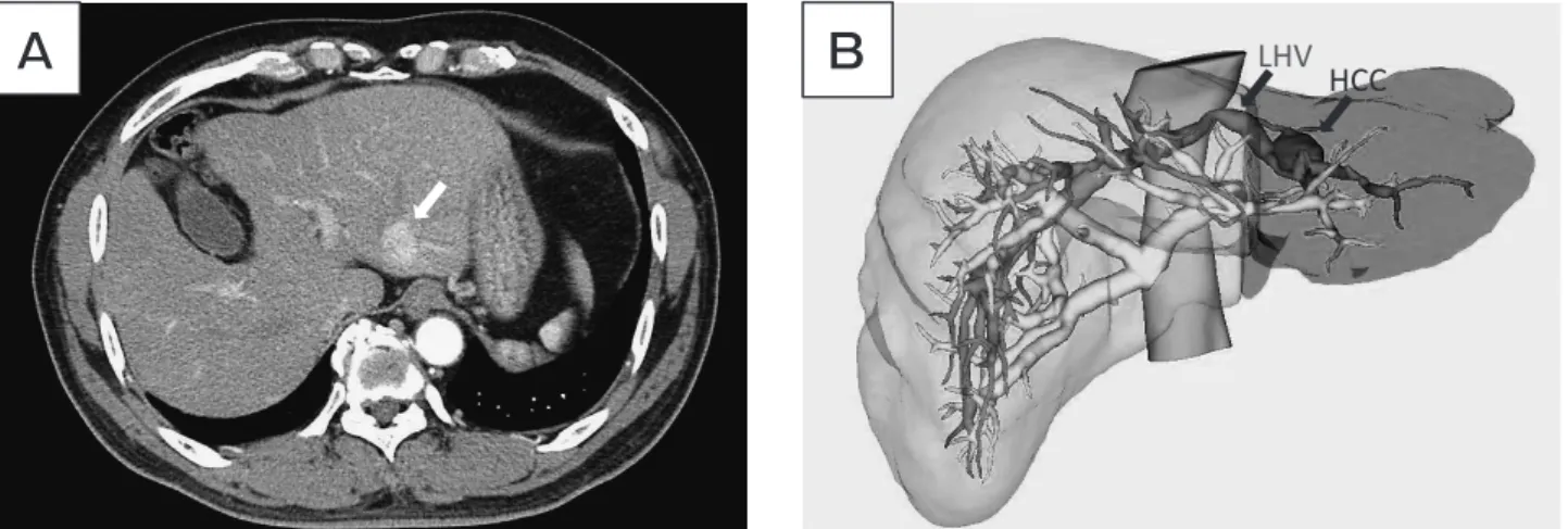 Fig. 1　 (A) Computed tomography (CT) images before liver resection.  Dynamic CT scan showing HCC of 2.1 cm in diameter,  located at  segment II