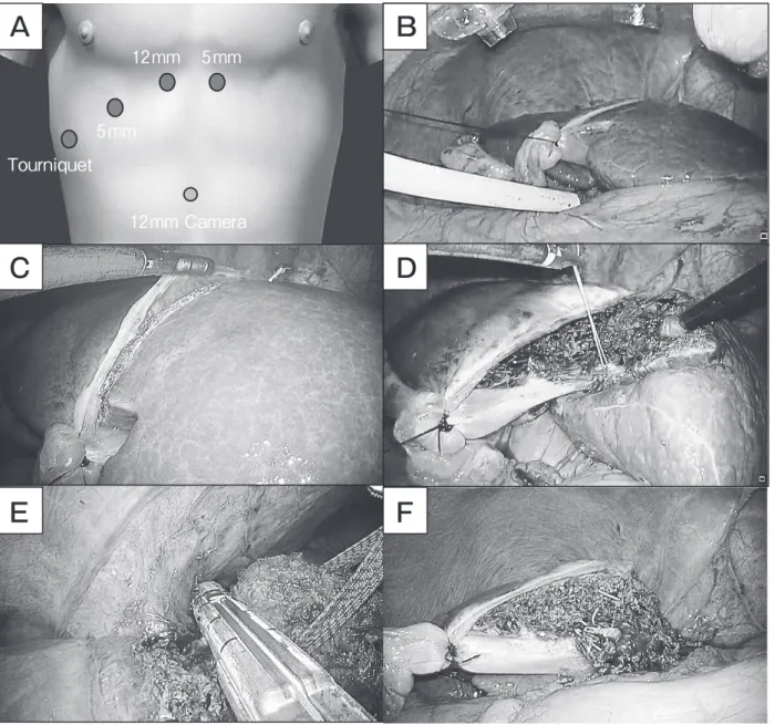Fig. 2　 (A)  Trocar  placement  for  laparoscopic  left  lateral  segmentectomy.   (B)  Tourniquet  method  with  a  20  Fr  silicone  tube