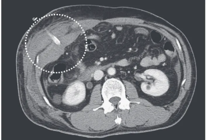 Fig. 3　 Dynamic CT scan showing intra-abdominal wall bleeding  around the drain site.