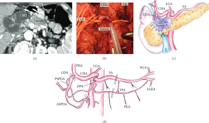 Figure 1: Indication of PD-SAR according to MDCT findings (a), intraoperative findings ((b) dotted circle indicates tumor border and schema of intraoperative findings) (c), and the arterial anatomy around the pancreas ((d) double line indicates cutting sit
