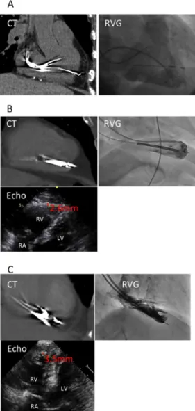 Fig 1. Panels A, B, and C show non-ECG-gated MDCT, RVG and echocardiography images, representatively, of a patient