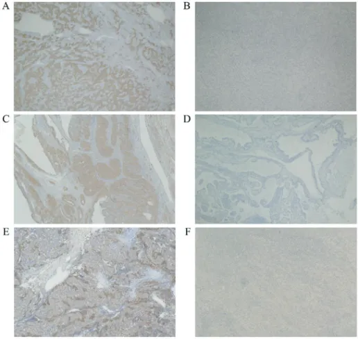 Figure 1. Microscopic results presenting the expression of NY‑ESO‑1 and MAGE‑A4 in synovial sarcoma (magnification, x40)