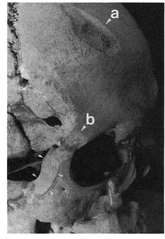 Fig. 1.  The  upper  part  of  the  facial  skull,  viewed  from     the  right  front