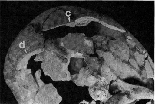 Fig.  2.  The  cranial  vault,  viewed  from  right-inferior-rear.  Note  the  injuries  to  both  the  right     parietal  (c) and the  occipital  (d) bones