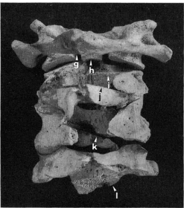 Fig.  8.  The  upper  four  cervical  vertebrae  articulated,  viewed  from  behind.  Note  the  injuries     to  the atlas  (g), to  the  axis  (h), (i) and  (j), and  to  the  third  (k) and  fourth  (1) cervical vertebrae , 