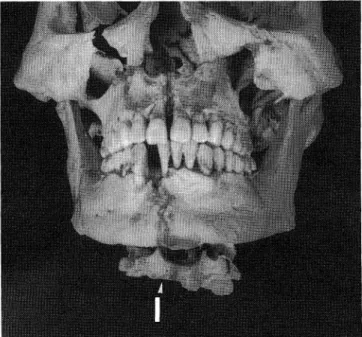 Fig.  9.  The  skull  and  upper  four  cervical  vertebrae  articulated,     viewed  from  front