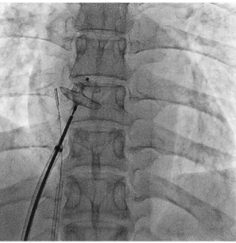 図 2 　Amplatzer  PFO  occluder（国内未 承認）