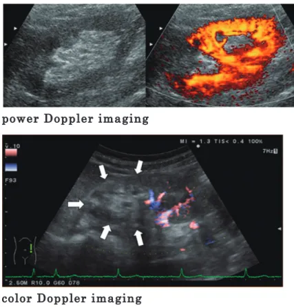 Fig. 22  腎 塞急性期の超音波像（腎臓長軸像）