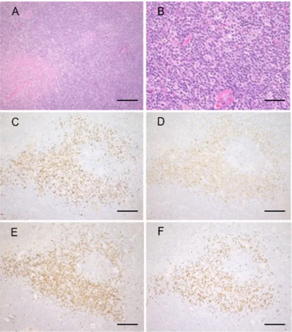 Figure 2. Marginal zone lymphoma with IgG4-positive cells. Representative pathological images  of marginal zone lymphoma with IgG4-positive cells