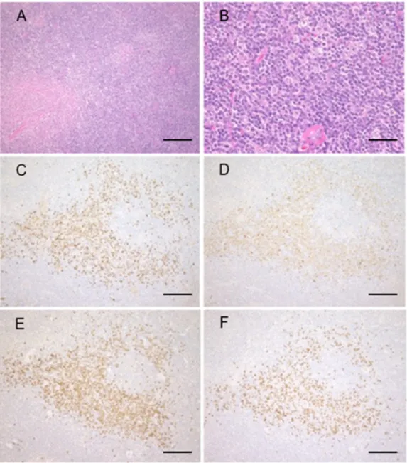 Figure 2. Marginal zone lymphoma with IgG4-positive cells. Representative pathological images  of marginal zone lymphoma with IgG4-positive cells
