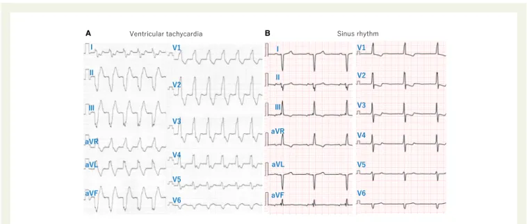 Figure 1 The electrocardiogram during ventricular tachycardia (A) show complete right bundle branch block, superior axis, and QRS duration of 156 ms