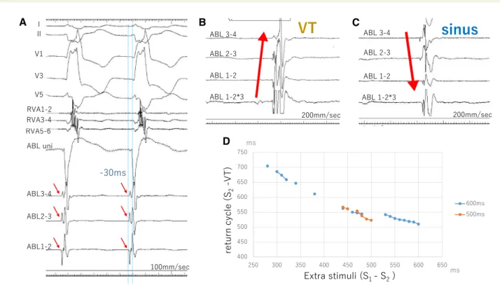 Figure 4 (A) The earliest activation potential during ventricular tachycardia is preceded by 30 ms from onset of QRS, in which Purkinje potential (red arrows) was recorded