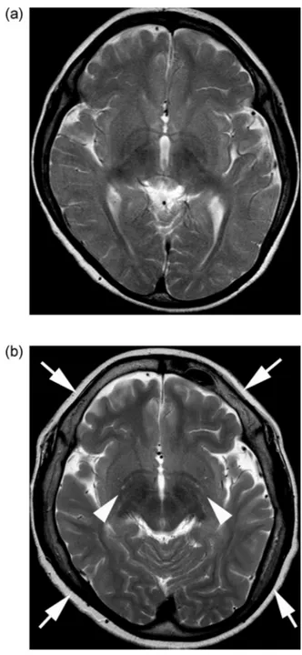 Fig 1 – Axial T2-weighted imaging at (A) 6 years and (B) 12 years of age showing progressive cranial hyperostosis (arrows) and worsened cerebral atrophy with faintly dilated perivascular spaces (arrowheads).