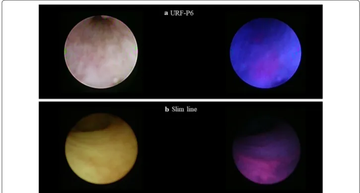 Fig. 1  Two different white light negative and ALA-PDD positive lesions using flexible URS (URS-P6, a) and semi-rigid ureteroscopy (Slim line, b)  followed by diagnosis with carcinoma in situ