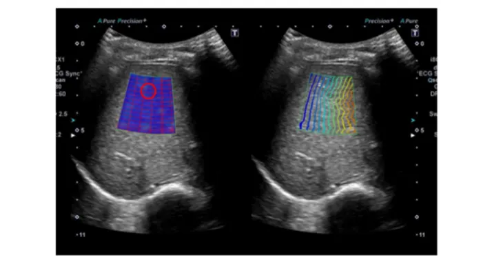 Figure 1 Shear wave elastography. Shear wave elastography was performed on the right lobe of the liver through intercostal spaces