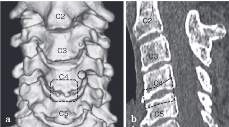 Fig.  1 The typical extent of corpectomy at C4／5 as repre- repre-sented by the images of case 6