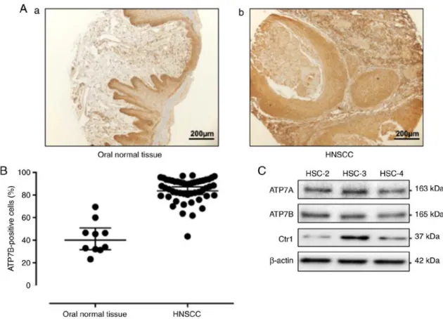 Figure 1. Expression of ATP7B in head and neck normal tissues, head and neck cancers, and human oral squamous cell lines