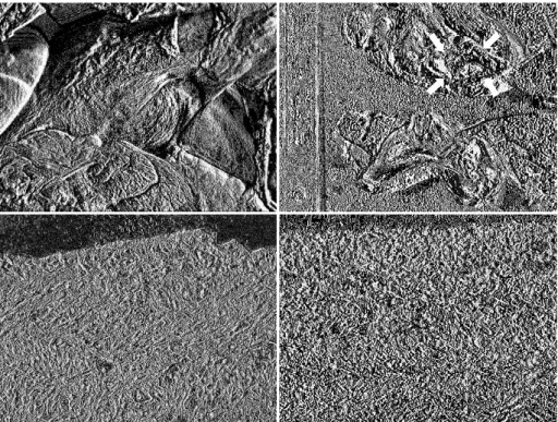 Fig. 4 : Gross and microscopic findings. The surface of the cyst was smooth and was covered  with a thin capsule （ａ）