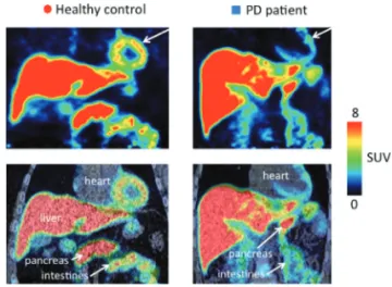 Figure 3  PD 症例における小腸および膵臓のコリンエステラー