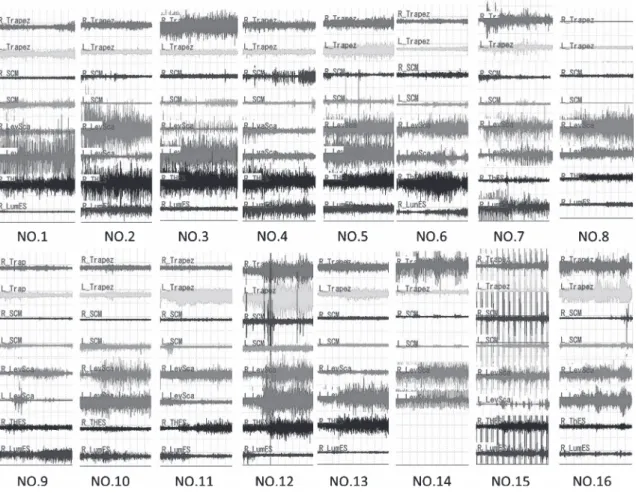 Fig. 4 Change of EMG activities during tilting table test.