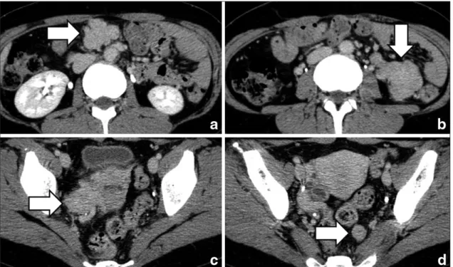 Fig. 1 Abdominal  CT  shows  4  enhanced  tumors  with  irregular  borders  of  the  superior  mesenteric  artery  (a),  right ovary (b), descending colon (c) and pelvic wall (d) (arrows).